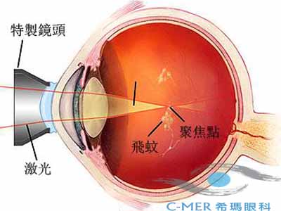 激光治疗飞蚊