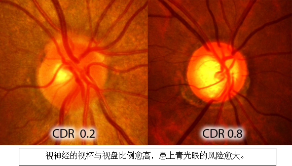 青光眼视神经检查