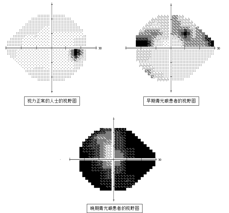 青光眼视野图