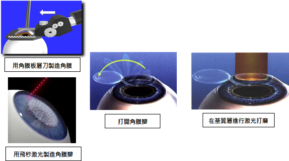 飞秒激光手术步骤