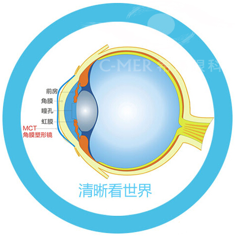 角膜塑形镜