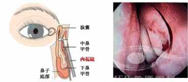 成人泪道阻塞治疗攻略：泪囊鼻腔吻合手术