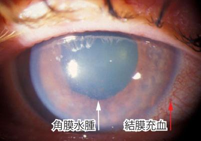 急性闭角性青光眼的6个发展时期