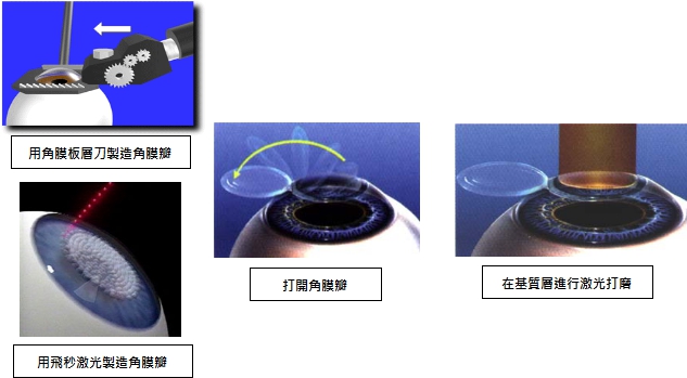 近视矫正手术的两类方法