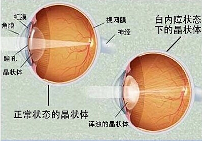 白内障和老花眼，你懂得区分吗？