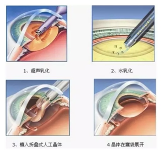 白内障和老花眼，你懂得区分吗？